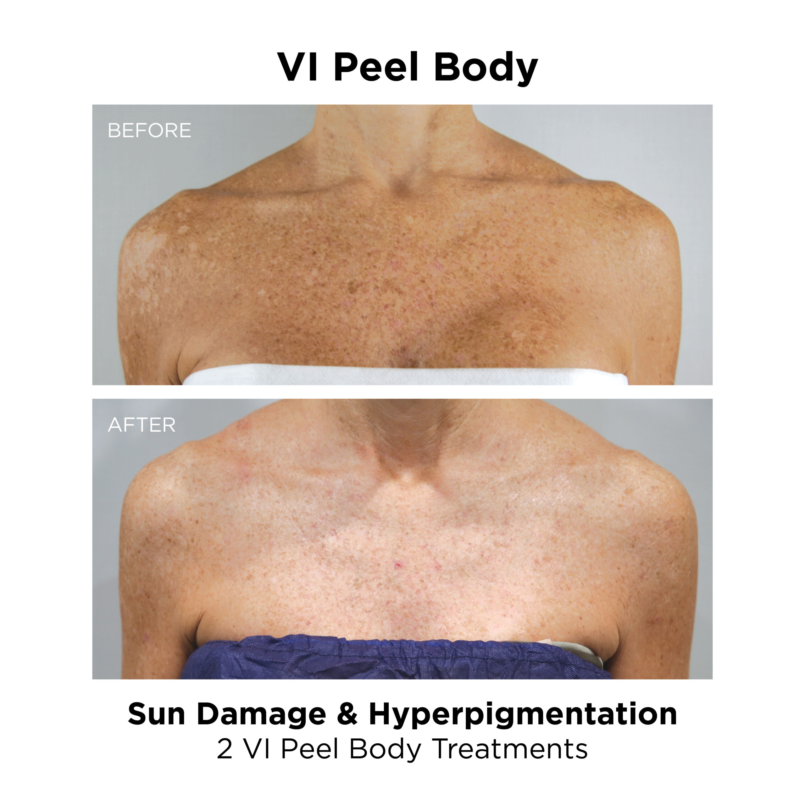 VI Peel Body_Sun Damage