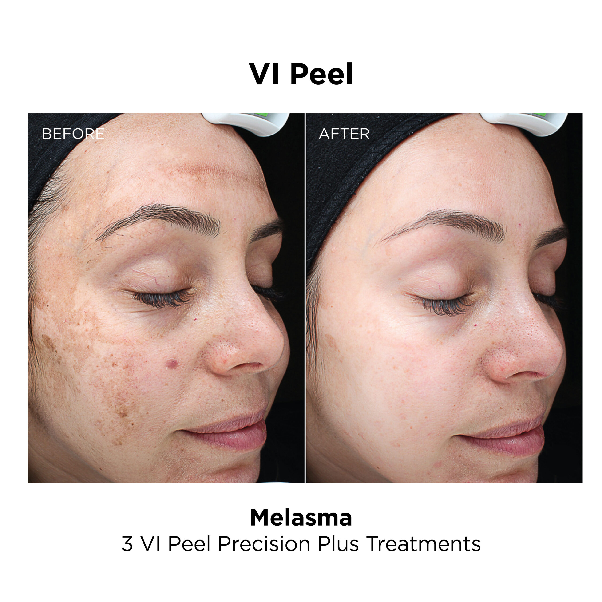 VI Peel_Melasma_Precision Plus (1)